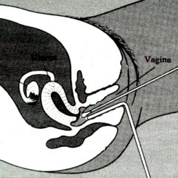 Exame na vagina